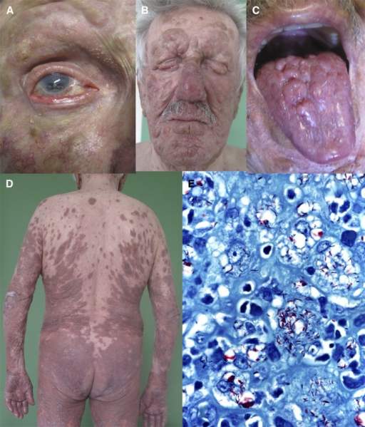 A 77-year-old man from Italy with borderline lepromatou ...