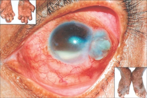 Scleral Perforation And Iris Prolapse Inset Showing Tropic Ulcer Extensive Tissue Loss Scleral Perforation And Iris Prolapse Inset Showing Tropic Ulcer Extensive Tissue Loss