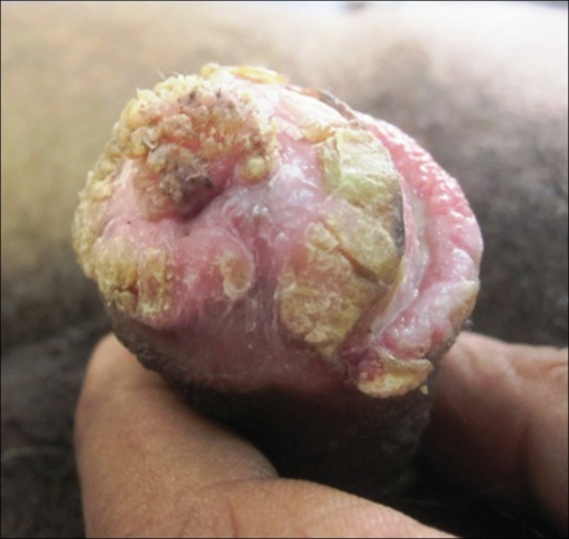 Actinic Keratosis Lesion Photos - Dermatology Education