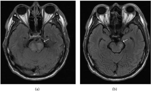 mri-with-increased-signal-intensity-on-t2-weighted-flai-open-i