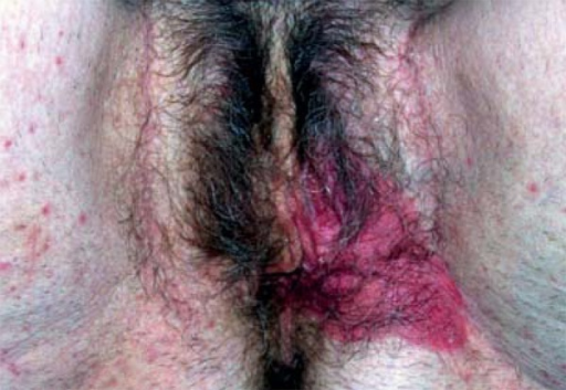 Pagets disease of the vulva picture picture 701