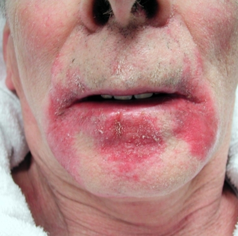 Prior To Botulinum Toxin Injections Into The Salivary G 