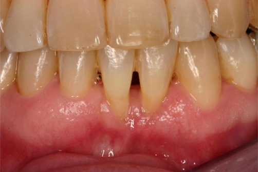 Clinical situation after orthodontic treatment showing | Open-i