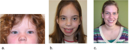 Variable Facial Features In Girls With Trisomy X A E Open I