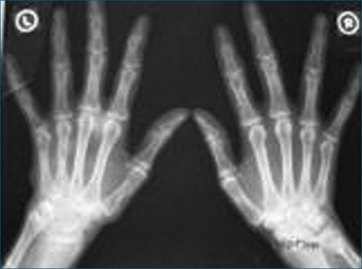 X- ray both hands showing multiple cystic lesions on th | Open-i