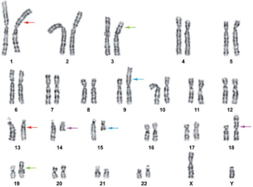 Cytogenetic analysis. Karyotype from a peripheral blood | Open-i