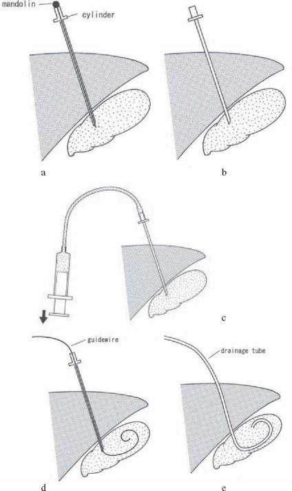 Percutaneous transhepatic gallbladder drainage (PTGBD) | Open-i