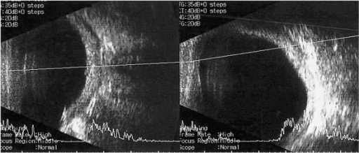 B Scan Ultrasound In Case 1 Showed Thickened Eyeball And Choroidal Detachment The Left B Scan Ultrasound In Case 1 Showed Thickened Eyeball And Choroidal Detachment The Left