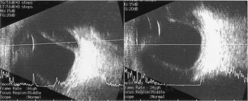 B Scan Ultrasound In Case 2 Showing Thickened Eyeball Peripheral Retinal Detachment And Choroidal B Scan Ultrasound In Case 2 Showing Thickened Eyeball Peripheral Retinal Detachment And Choroidal