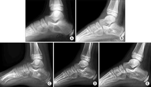 Simple bone cyst of the calcaneus in a 12-year-old boy. | Open-i