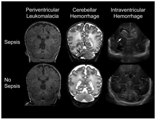 Developmental Disabilities Medlineplus >> Representative T1-weighted image of periventricular leu | Open-i Developmental Disabilities Medlineplus >> Representative T1-weighted image of periventricular leu | Open-i