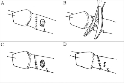 Lateral skin fold (shoulder) from Byars’ flap is dema | Open-i