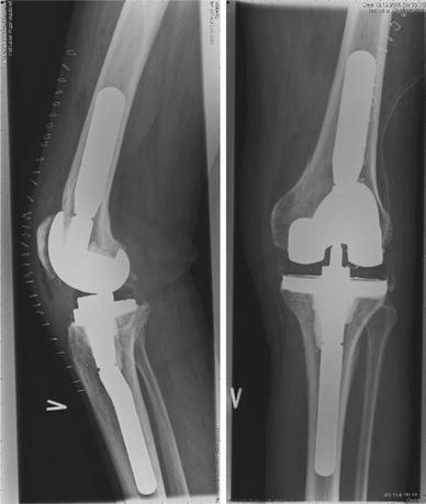 Cemented revision total knee arthroplasty (rTKA) with a | Open-i