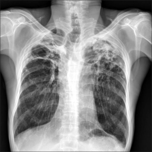 Initial chest X-ray showing old scar of pulmonary tuber | Open-i