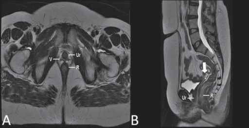 Turner syndrome. Multiplanar MRI T2-weighted sequence ( | Open-i