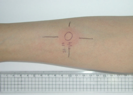 Tuberculin Test Was Performed After The Patient Was Sta Open I   PMC1634852 1471 2334 6 154 2 