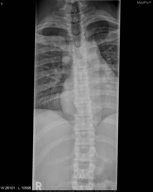 Thoracic Spine Pa View Multiple Bony Erosions Associa Open I