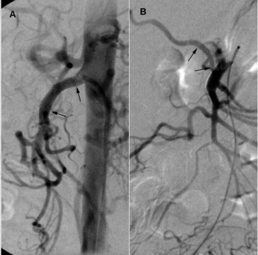 Digital subtraction angiography of the superior mesente | Open-i