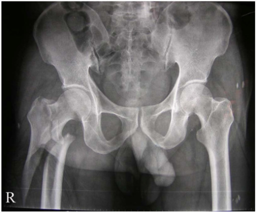 Intertrochanteric Fracture Orif