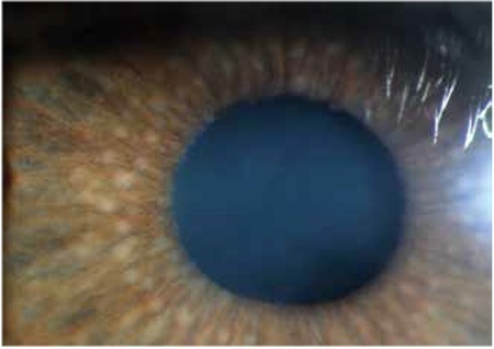 Koeppe nodules at the pupillary border and Busacca nodu | Open-i