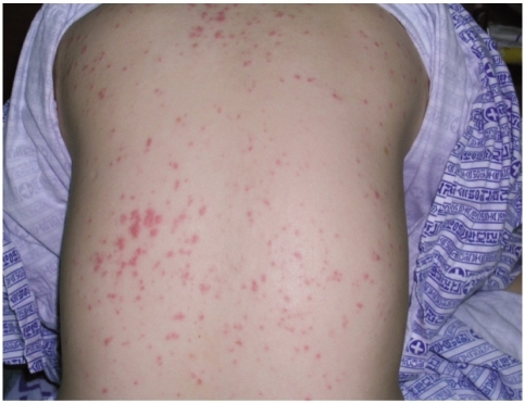 Rash on the back of the patient. Diffuse erythematous p | Open-i