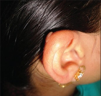 Ear Keloid Custom Acrylic Compression Pressure Earring, Made to