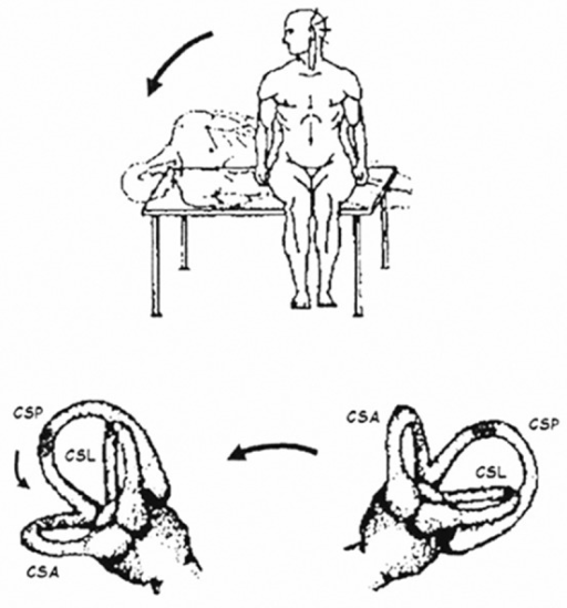 Schematic representation of demi Semont maneuver for a | Open-i