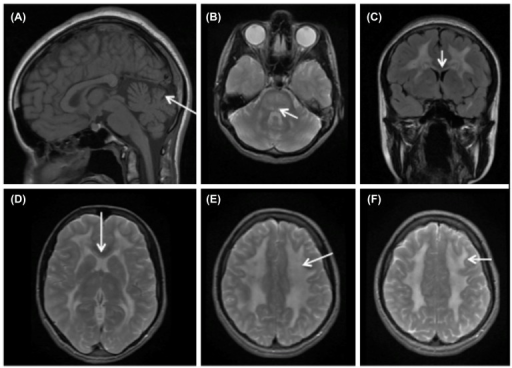 Brain MRI findings in MNGIE. MRI of MNGIE patient at age 16 with ...