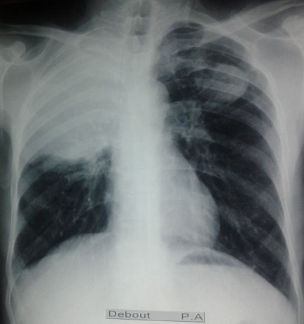 Radiographie Thoracique De Face Montrant Une Double Loc Open I Radiographie Thoracique De Face Montrant Une Double Loc Open I
