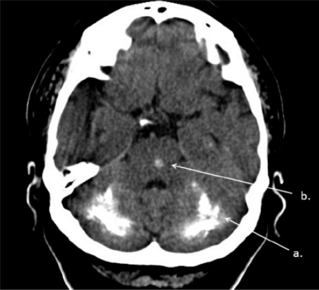 Brain CT. Bilateral massive calcifications of cerebella | Open-i