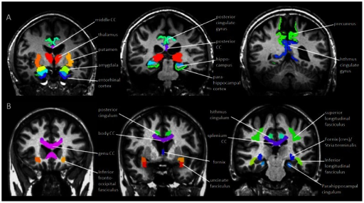 GM and WM parcellations.A. Automated parcellation of 21 | Open-i