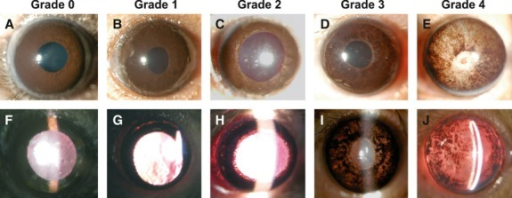 Appearance of anterior segment and iris transilluminati | Open-i