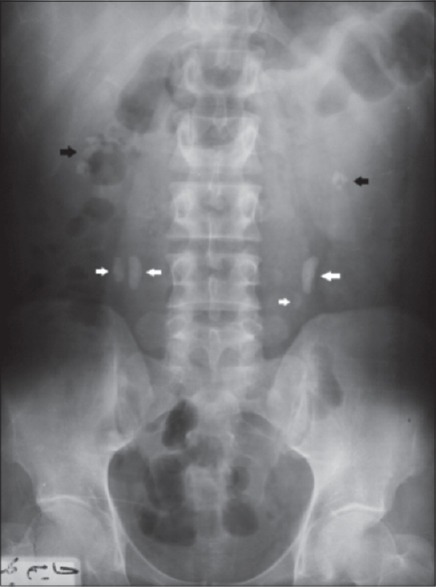 Abdominal X Ray Showing Multiple Bilateral Renal Stones Open I   PMC4839245 UA 8 226 G001 