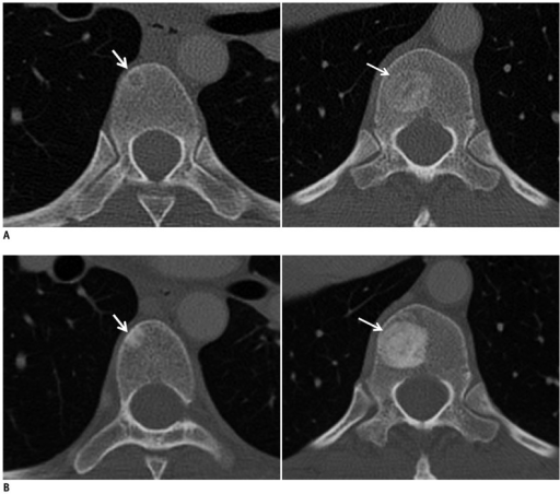 bone breast cancer metastatic vertebra Hep c and sex
