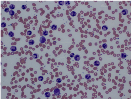 Peripheral blood smear Extreme leukocytosis with large 