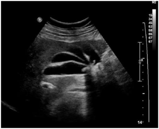 Gallbladder Fold Ultrasound