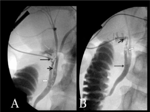 Intraoperative Cholangiogram A Initial Intraoperative Open I