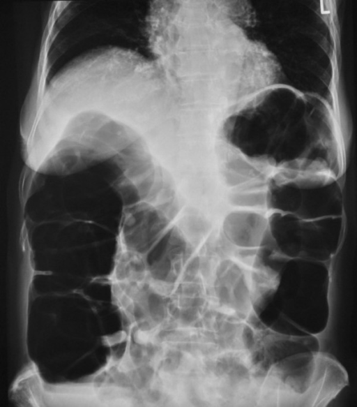 Abdominal X Ray Of Patient 1 At First Presentation Not Open I