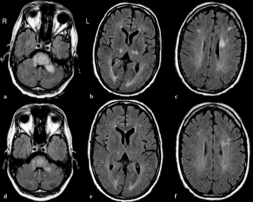 A–c T2-weighted Mri Of The Brain, Demonstrating Hyper 