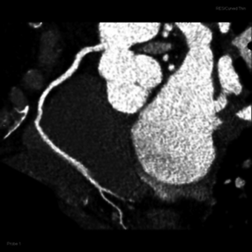 Cardiac CT. Curved multiplanar reformated (MPR) image s | Open-i