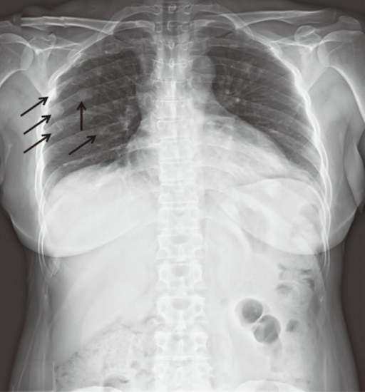 chest-x-ray-showing-an-infiltrative-lesion-and-cavitation-in-the-right