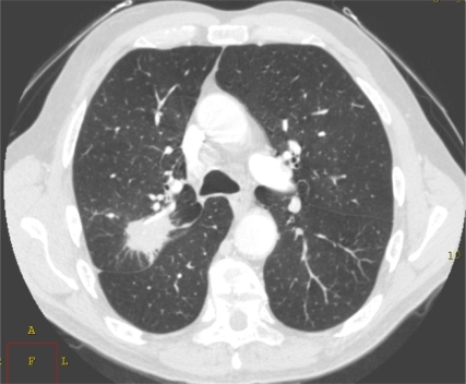 A spiculated mass is shown in the right upper lobe. | Open-i