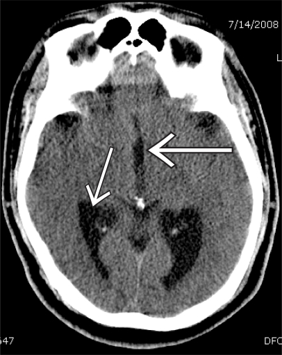 Hydrocephalus with enlarged lateral and third ventricle | Open-i