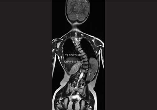 Coronal Lumbar Mri