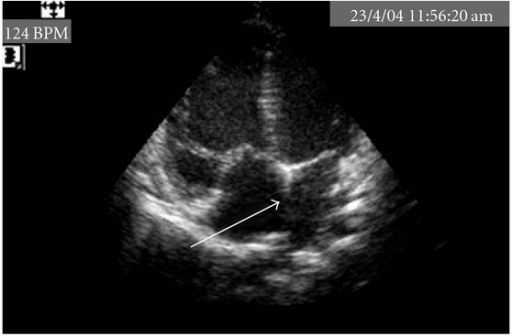 Echocardiography showing ostium secundum atrial septal | Open-i