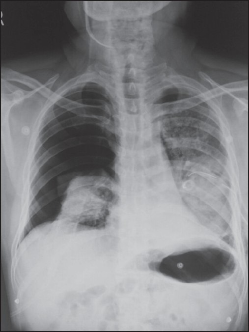 How To Diagnose Pneumothorax On Chest X Ray at Ava Felipe blog