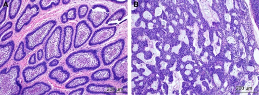 Histopathology of ameloblastoma. (A) The follicular pat | Open-i