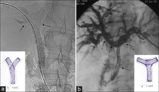 Configuration Of Metallic Biliary Stents (a) Y-shaped: | Open-i