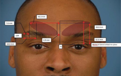 Comprehensive Corrugator Supercilii Muscle Topographic | Open-i