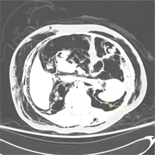 Transverse section of CT abdomen showing subcutaneous e | Open-i